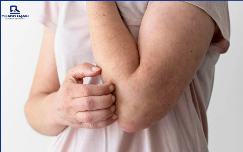 nổi mề đay có nằm quạt được không