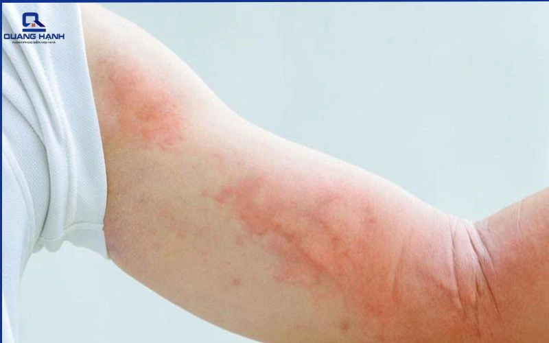 nổi mề đay có nằm quạt được không