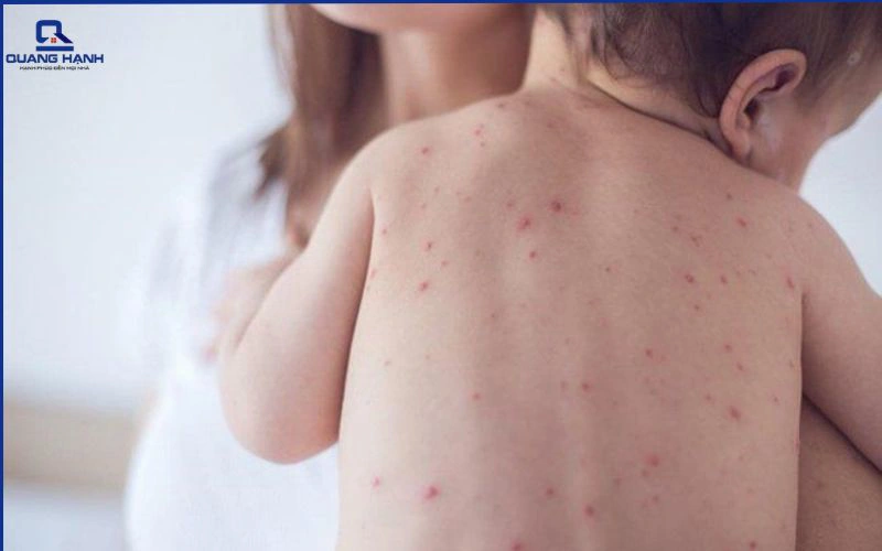 Sốt phát ban có được nằm quạt không 